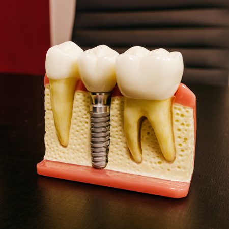 implant implant